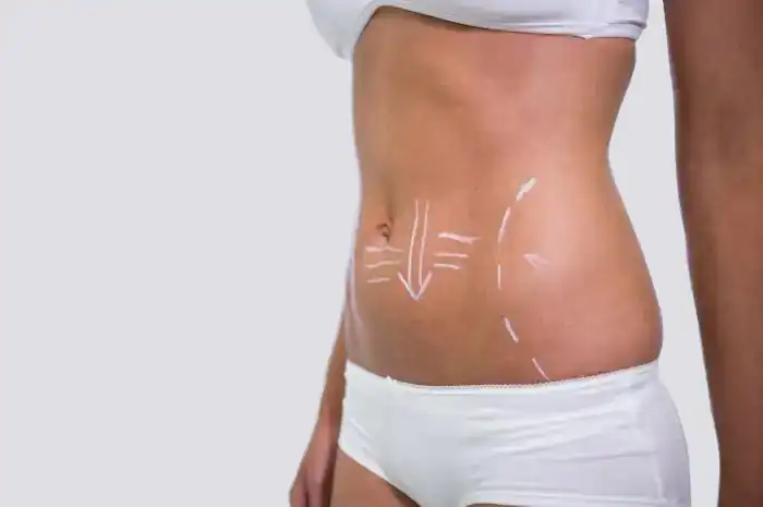 Liposuctie Liposuctie